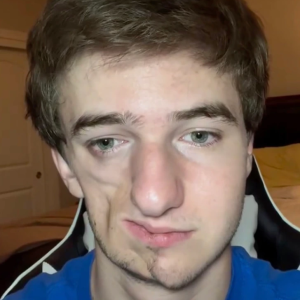 Meet Lukas Caldwell: Living with Parry-Romberg Syndrome and Inspiring Millions